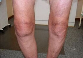 Cómo tratar la artrosis de la rodilla articulación
