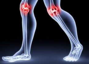 Las causas del desarrollo de la artrosis de la rodilla