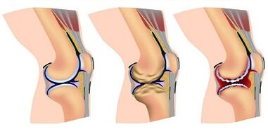 Etapas de desarrollo de artrosis de rodilla