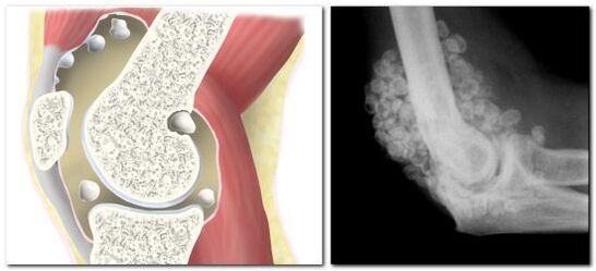 condromatosis con dolor de cadera