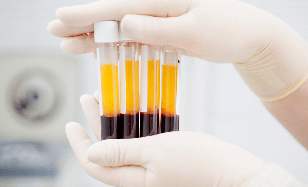 Plasma rico en plaquetas para la terapia con PRP en la osteoartritis